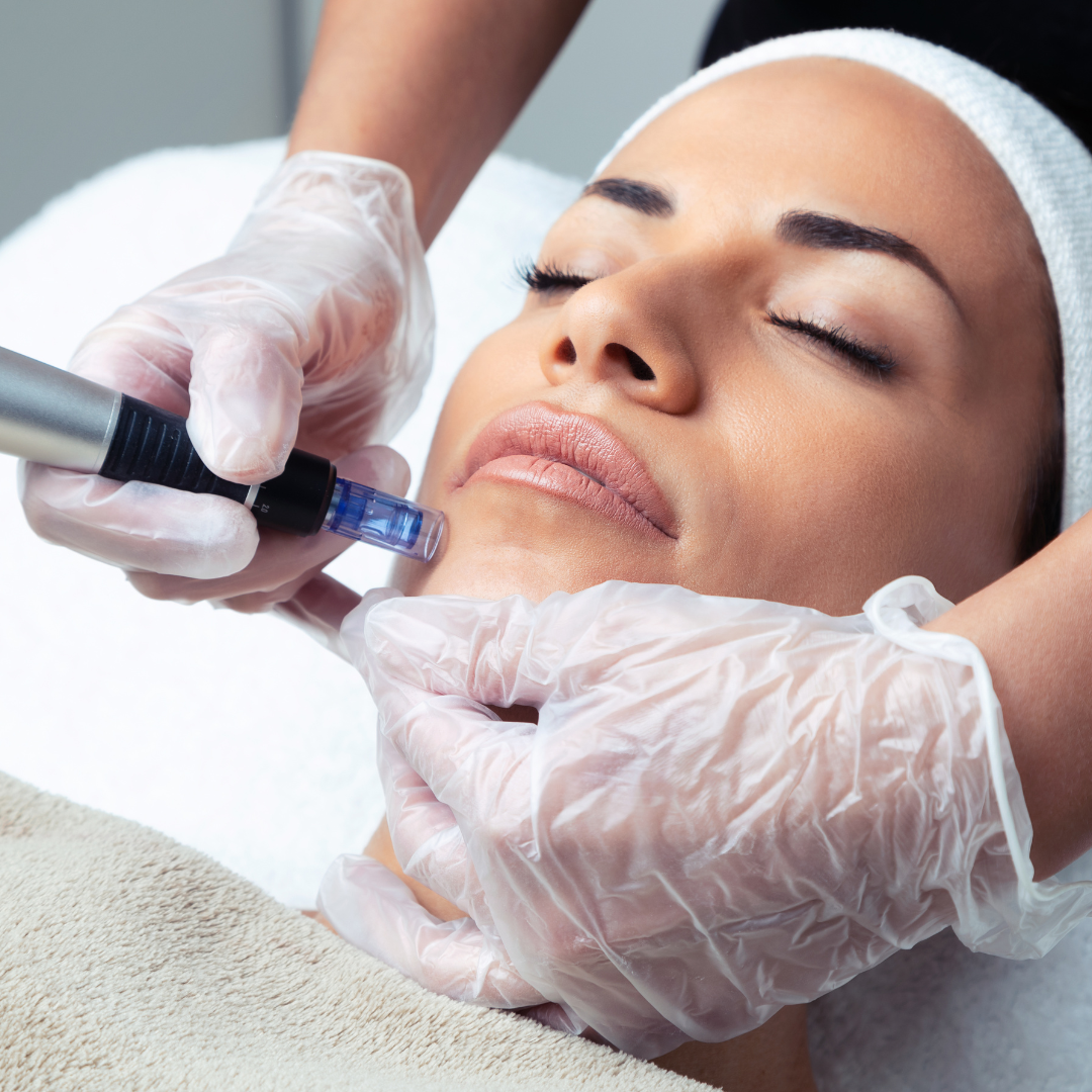 Skinpen Microneedling