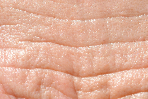 Get Rid Of Wrinkles In Florence Kentucky